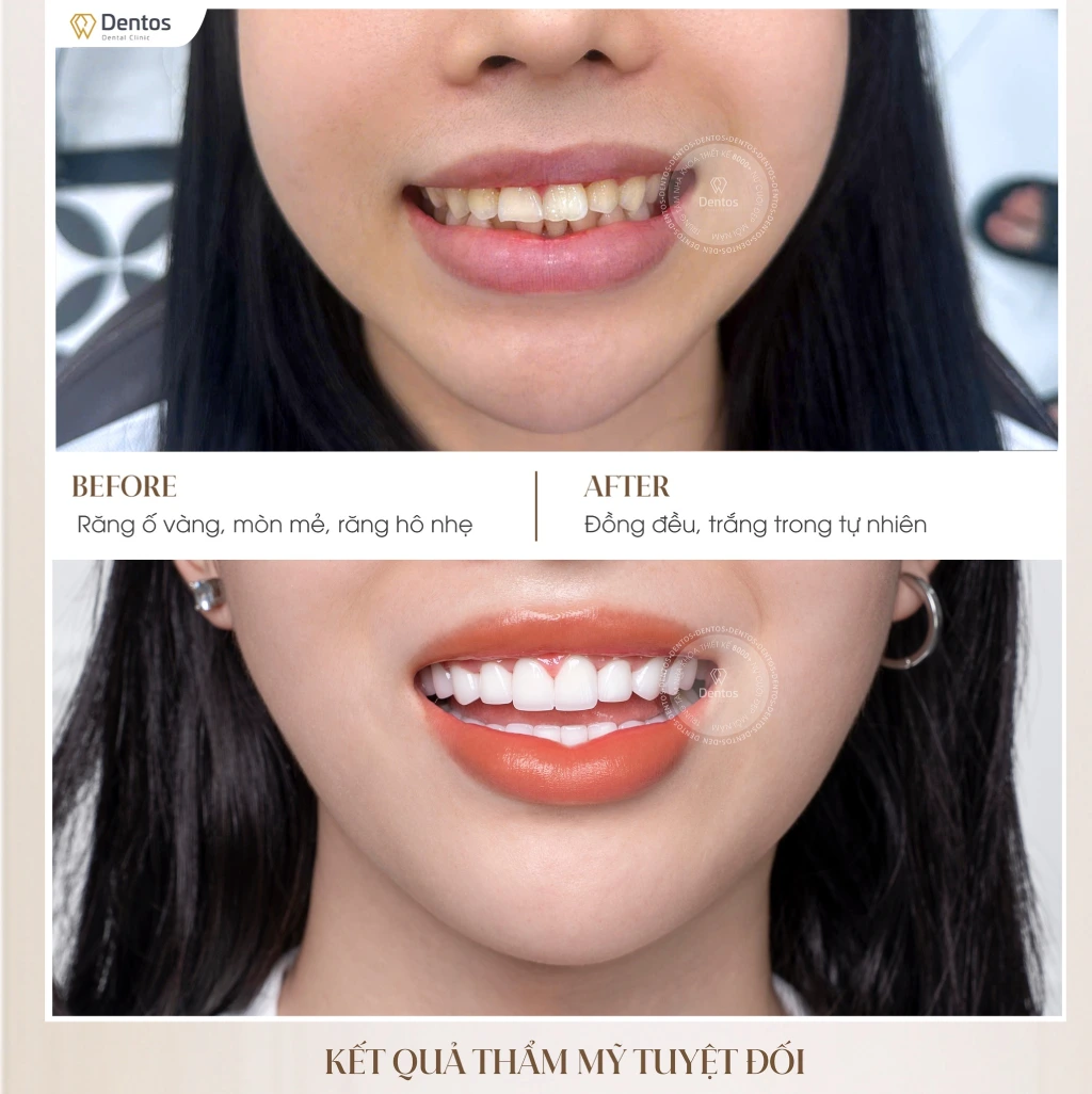 Răng sứt mẻ, vỡ lớn, ám màu nặng nên bọc răng sứ